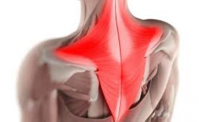 Trapezius syndroom en TCM